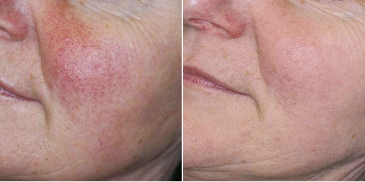 IPL-before_after-rosacea Two photos showing comparatively showing the results of IPL skin revitalization treatment for rosacea on a female patient .