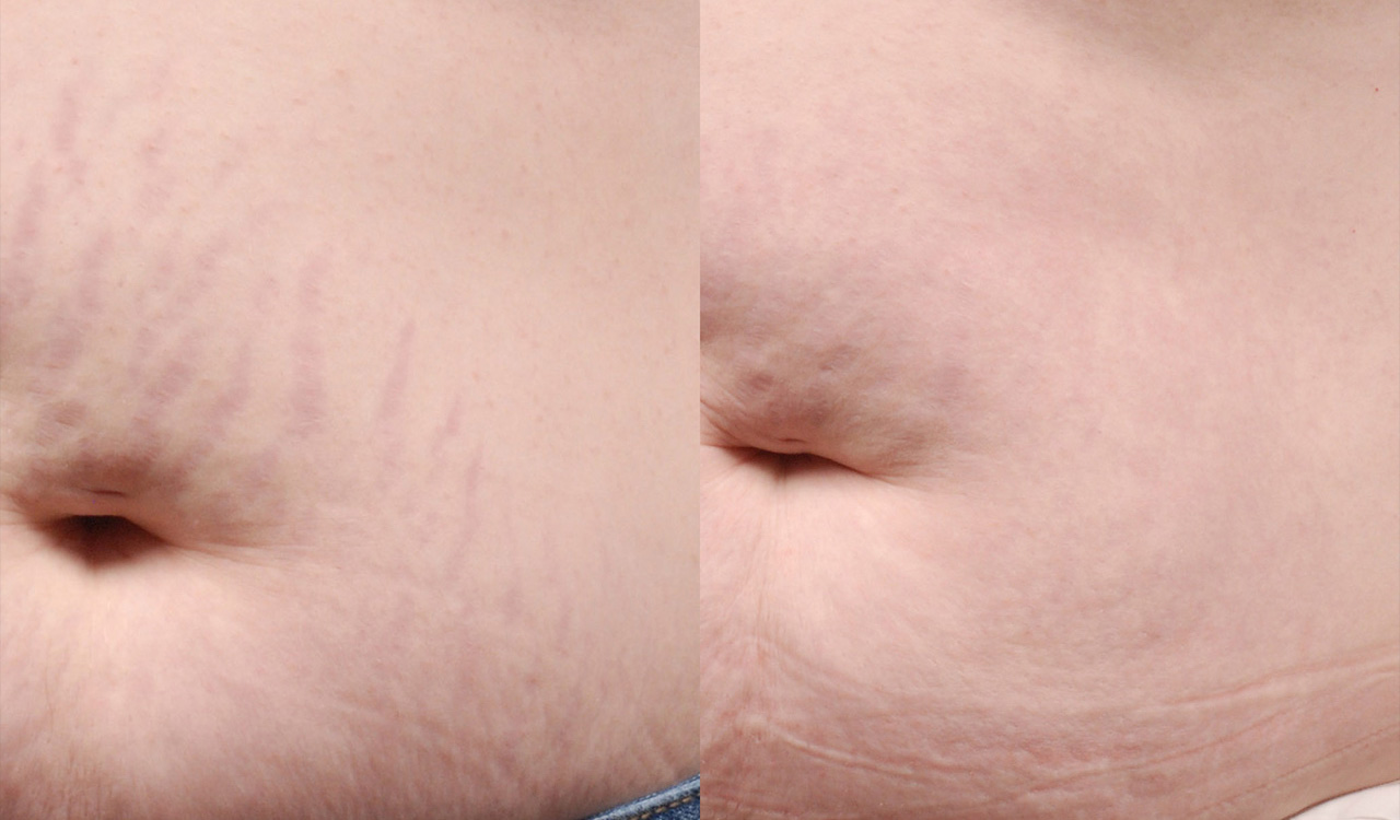 IPL-before_after-stretch_marks Two photos showing comparatively showing the results of IPL skin revitalization treatment for stretch marks on the abdominal skin of a male patient.