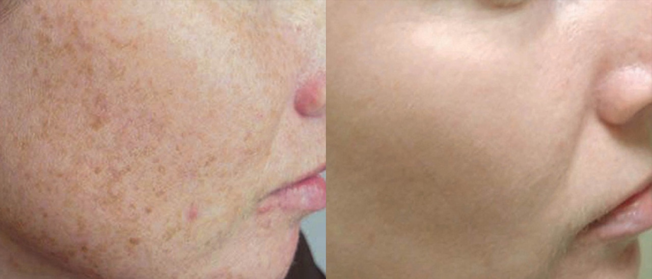 IPL-before_after-sun_damage Two photos showing comparatively showing the results of IPL skin revitalization treatment for sun damaged facial skin on a female patient.