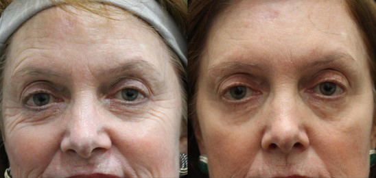 IPL-before_after-wrinkles
