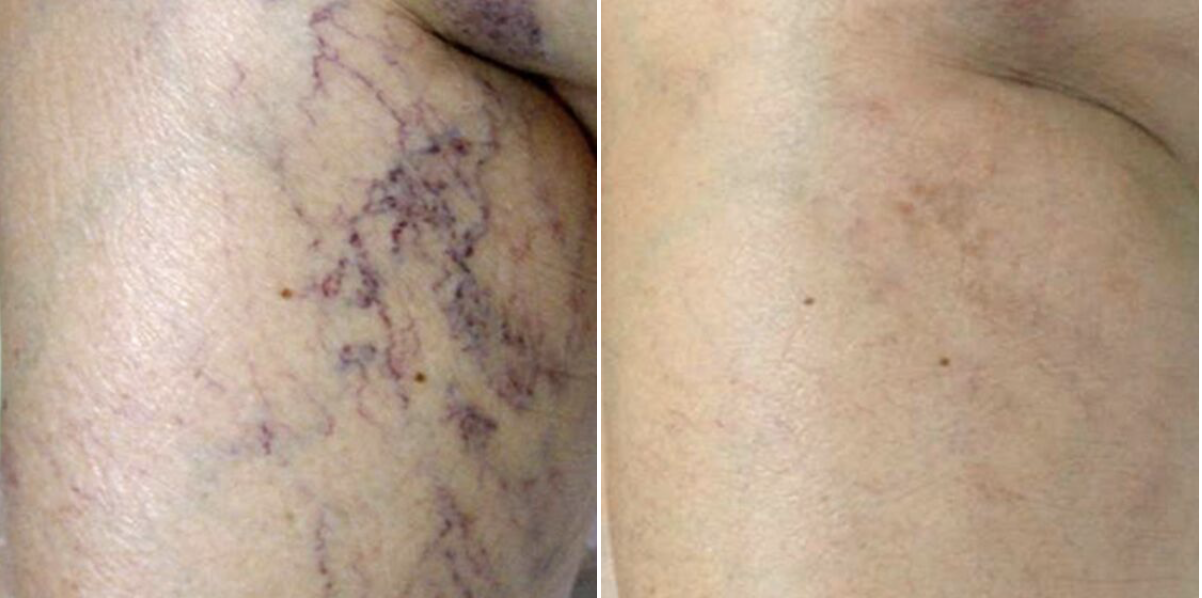Two photos showing comparatively showing the results of IPL vein removal treatment on calf on a female patient .