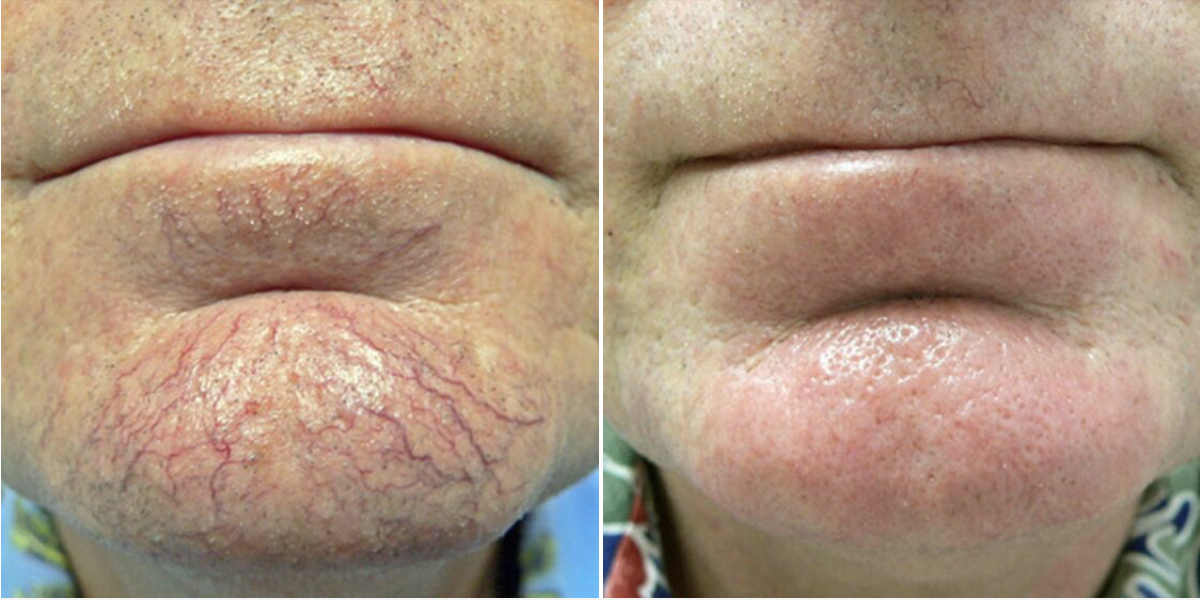 Two photos showing comparatively showing the results of laser vein removal treatment on chin of a male patient .