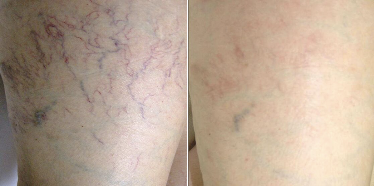 vein_removal-before_after-thigh Two photos showing comparatively showing the results of IPL vein removal treatment on thigh of a female patient .