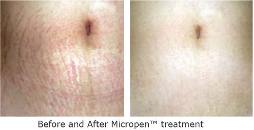 ottawa+microneedling